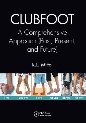 Clubfoot: A Comprehensive Approach (Past, Present, and Future) by R. L. Mittal