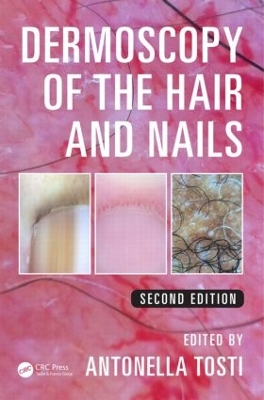 Dermoscopy of the Hair and Nails, Second Edition book