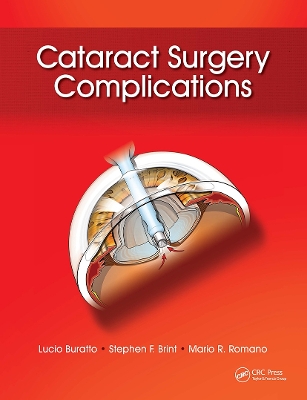 Cataract Surgery Complications by Lucio Buratto