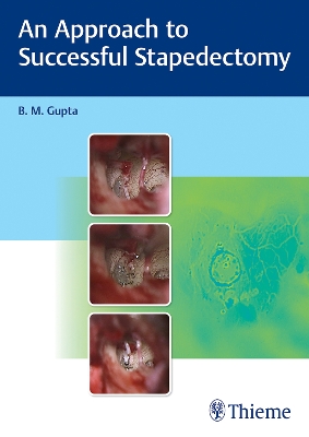 An Approach to Successful Stapedectomy book