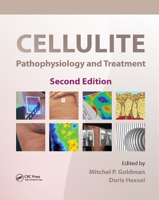 Cellulite: Pathophysiology and Treatment by Mitchel P. Goldman