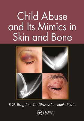 Child Abuse and its Mimics in Skin and Bone by B. G. Brogdon