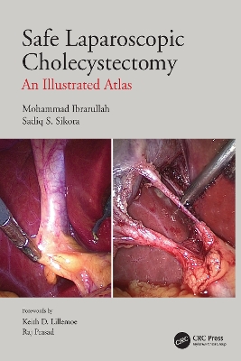 Safe Laparoscopic Cholecystectomy: An Illustrated Atlas by Mohammad Ibrarullah