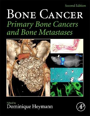 Bone Cancer by Dominique Heymann