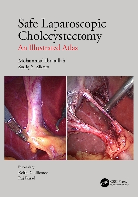 Safe Laparoscopic Cholecystectomy: An Illustrated Atlas book