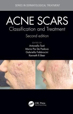 Acne Scars: Classification and Treatment, Second Edition book