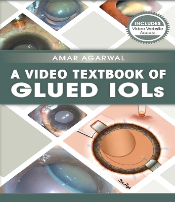 Video Textbook of Glued IOLs book