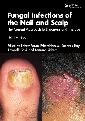 Fungal Infections of the Nail and Scalp: The Current Approach to Diagnosis and Therapy book