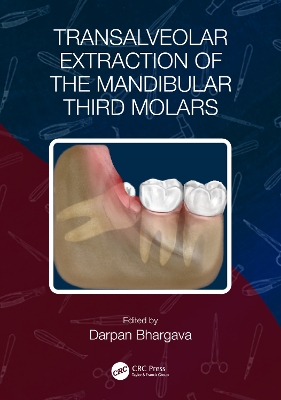 Transalveolar Extraction of the Mandibular Third Molars book