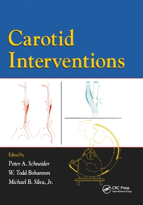 Carotid Interventions by Peter Schneider