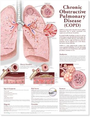 Chronic Obstructive Pulmonary Disease Anatomical Chart book