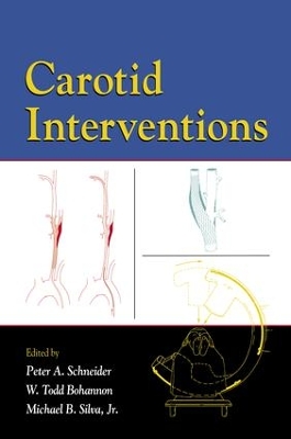 Carotid Interventions by Peter Schneider