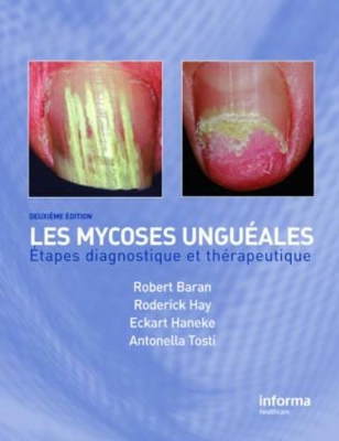Onychomycosis/Les Mycoses Ungueales by Antonella Tosti
