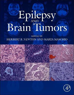 Epilepsy and Brain Tumors book