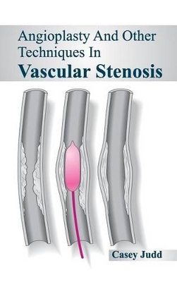 Angioplasty and Other Techniques in Vascular Stenosis book