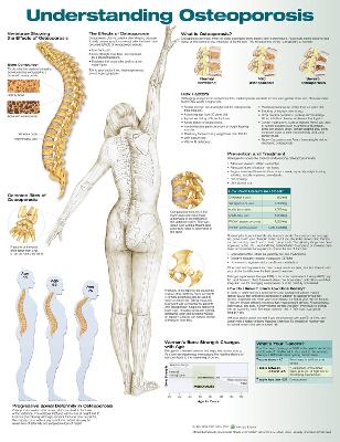 Understanding Osteoporosis Anatomical Chart by Anatomical Chart Company