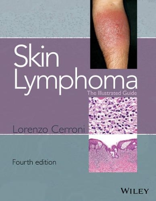 Skin Lymphoma by Lorenzo Cerroni