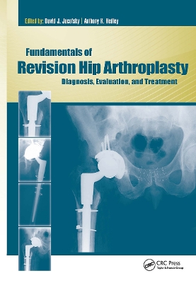 Fundamentals of Revision Hip Arthroplasty book