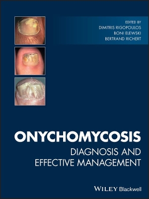 Onychomycosis: Diagnosis and Effective Management book