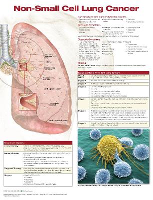 Non-Small Cell Lung Cancer by Anatomical Chart Company