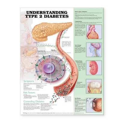 Understanding Type 2 Diabetes Anatomical Chart by Anatomical Chart Company