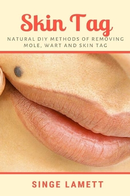 Skin Tag: Natural DIY Methods of removing Mole, Wart and Skin Tag book