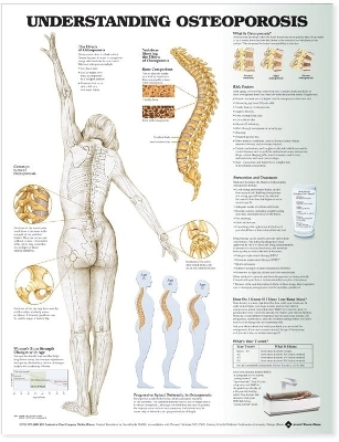 Understanding Osteoporosis Anatomical Chart by Anatomical Chart Company
