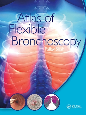 Atlas of Flexible Bronchoscopy book