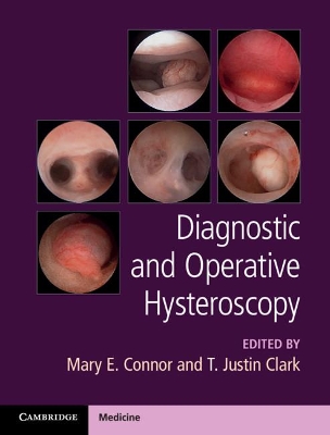 Diagnostic and Operative Hysteroscopy book