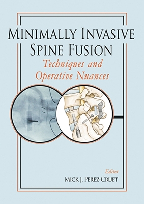 Minimally Invasive Spine Fusion: Techniques and Operative Nuances book