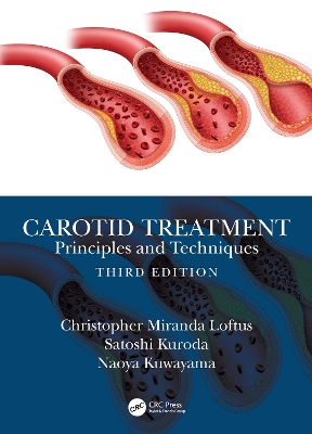 Carotid Treatment: Principles and Techniques book