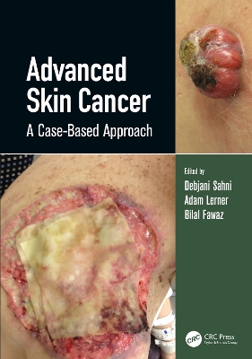 Advanced Skin Cancer: A Case-Based Approach by Debjani Sahni
