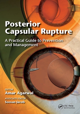 Posterior Capsular Rupture book