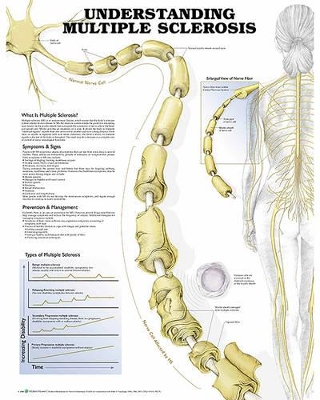 Understanding Multiple Sclerosis Anatomical Chart by Anatomical Chart Company