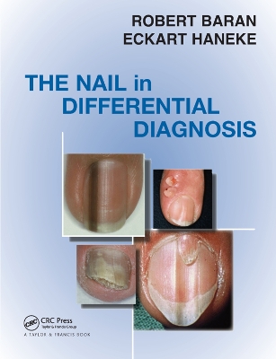 Nail in Differential Diagnosis by Robert Baran