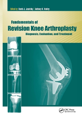 Fundamentals of Revision Knee Arthroplasty book