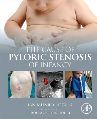 The Cause of Pyloric Stenosis of Infancy book