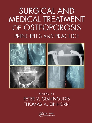 Surgical and Medical Treatment of Osteoporosis: Principles and Practice by Peter V. Giannoudis