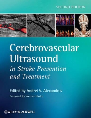 Cerebrovascular Ultrasound in Stroke Prevention and Treatment by Andrei V. Alexandrov
