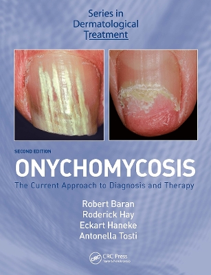 Onychomycosis: The Current Approach to Diagnosis and Therapy book