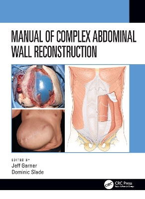 Manual of Complex Abdominal Wall Reconstruction by Jeff Garner