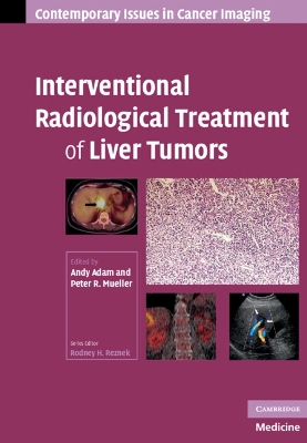 Interventional Radiological Treatment of Liver Tumors by Andy Adam