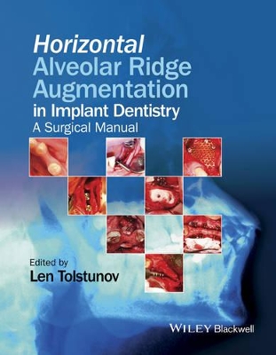 Horizontal Alveolar Ridge Augmentation in Implant Dentistry book