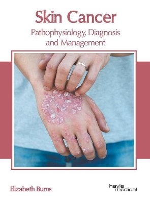 Skin Cancer: Pathophysiology, Diagnosis and Management book