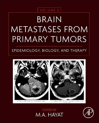 Brain Metastases from Primary Tumors, Volume 2 book