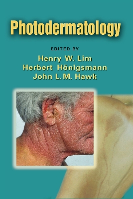 Photodermatology book