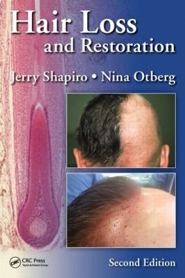 Hair Loss and Restoration book